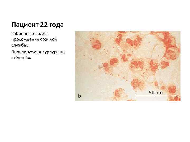 Пациент 22 года Заболел во время прохождения срочной службы. Пальпируемая пурпура на ягодицах. 