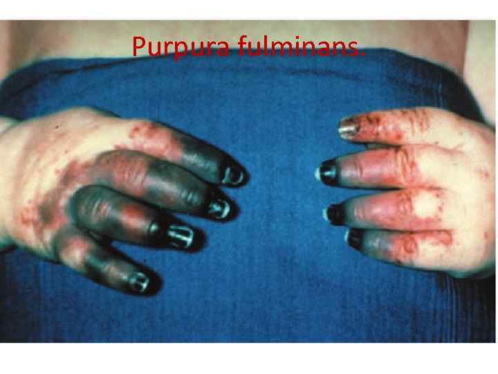 Purpura fulminans. 