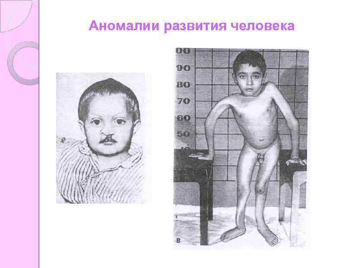 Аномалии развития человека 
