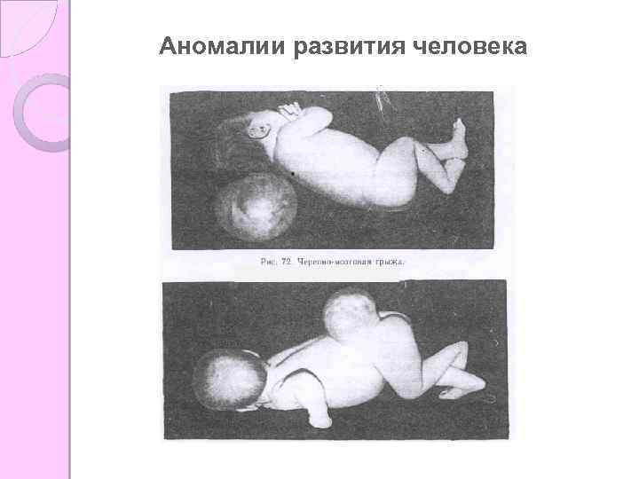 Аномалии развития человека 