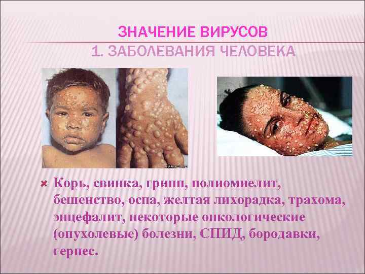 ЗНАЧЕНИЕ ВИРУСОВ 1. ЗАБОЛЕВАНИЯ ЧЕЛОВЕКА Корь, свинка, грипп, полиомиелит, бешенство, оспа, желтая лихорадка, трахома,