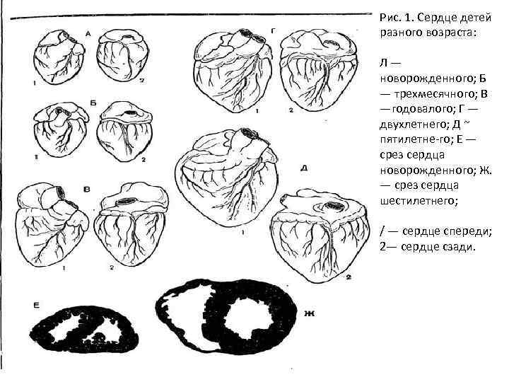 Рис. 1. Сердце детей разного возраста: Л— новорожденного; Б — трехмесячного; В —годовалого; Г