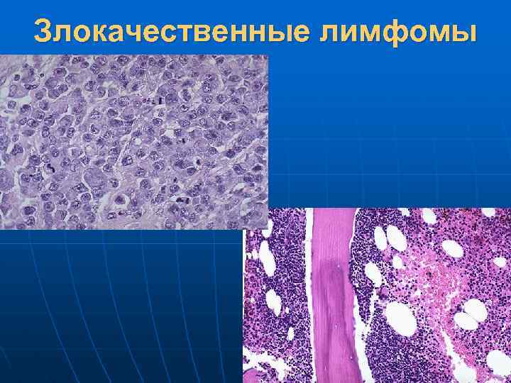 Гемобластозы патологическая анатомия презентация