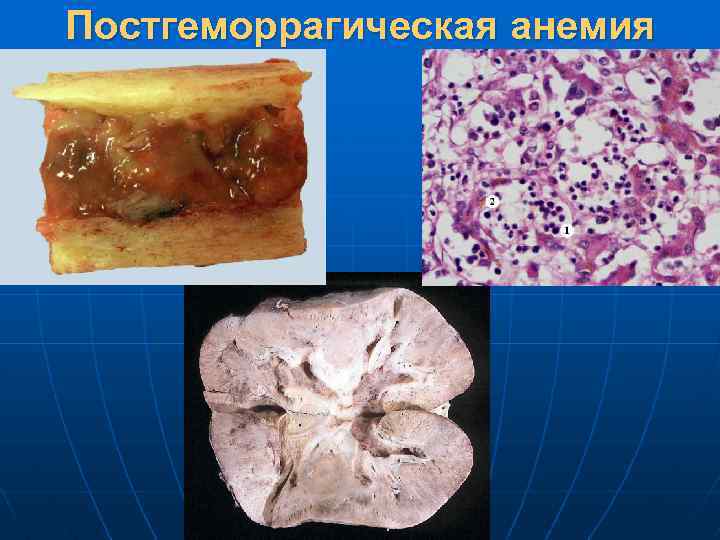 Постгеморрагическая анемия 