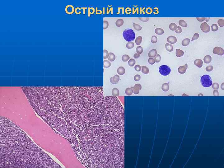 Гемобластозы патологическая анатомия презентация