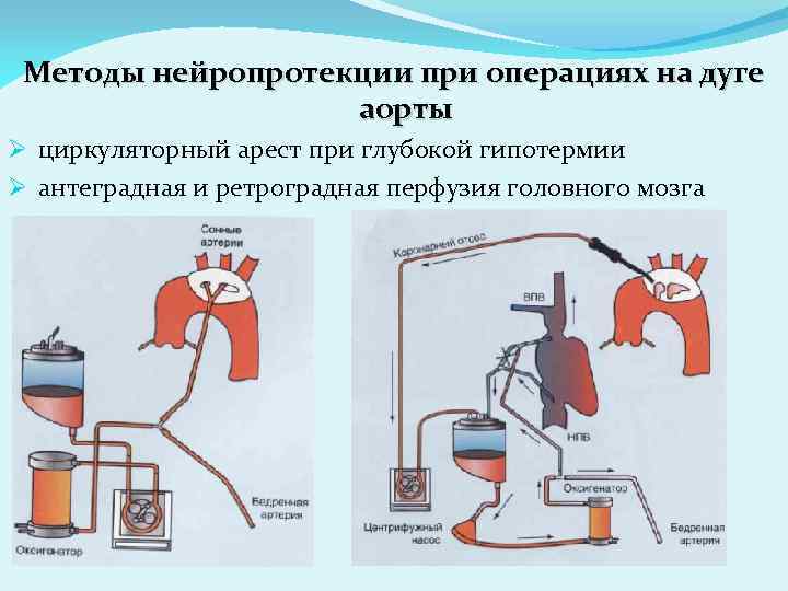 Методы нейропротекции при операциях на дуге аорты Ø циркуляторный арест при глубокой гипотермии Ø