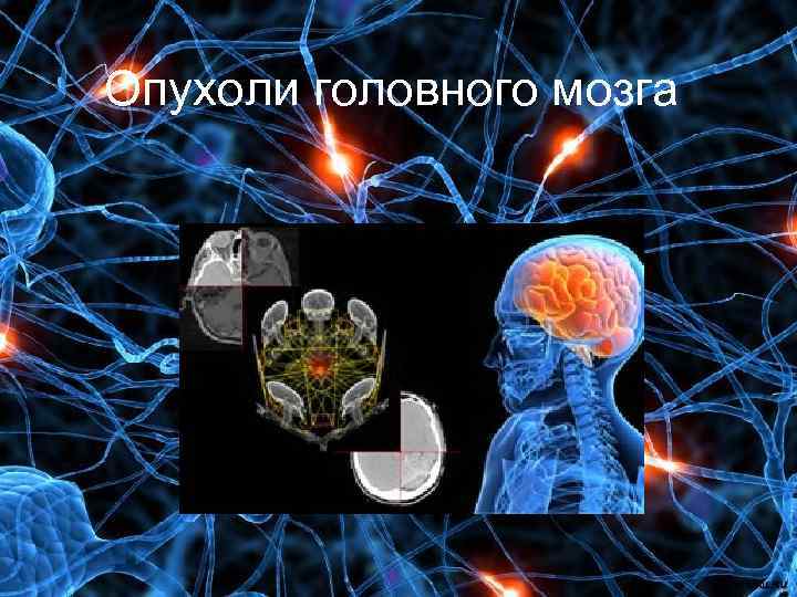 Neurotrauma. Опухоли головного мозга презентация. Презентация опухоль мозга. Опухоли головного мозга классификация.