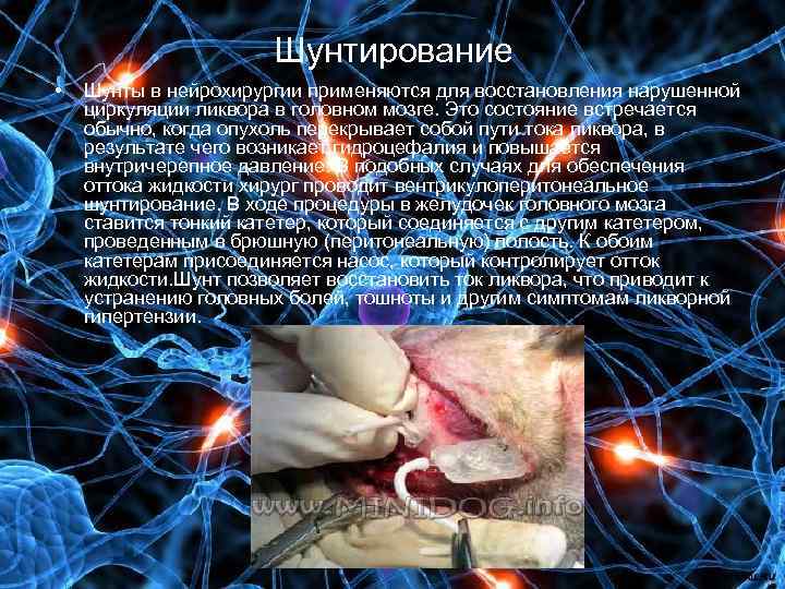 Шунтирование • Шунты в нейрохирургии применяются для восстановления нарушенной циркуляции ликвора в головном мозге.