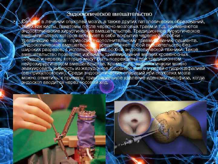 Эндоскопическое вмешательство • Сегодня в лечении опухолей мозга, а также других патологических образований, таких