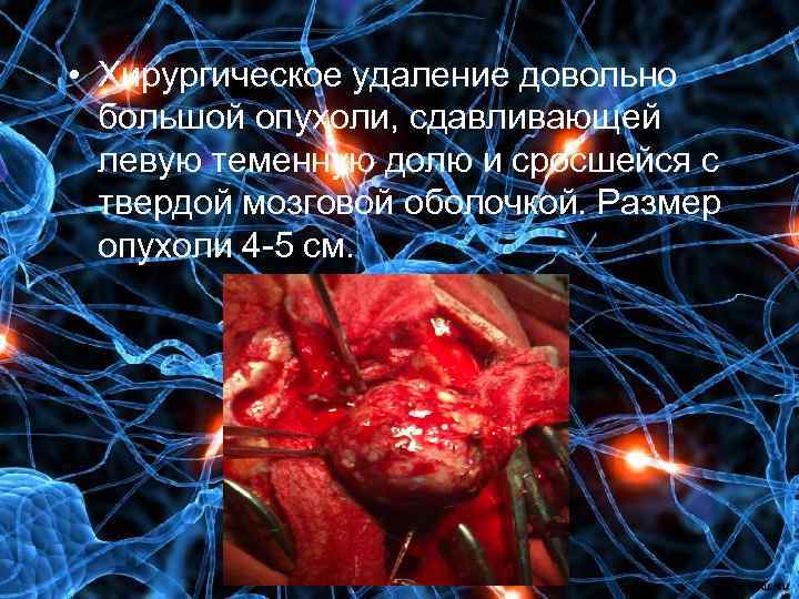  • Хирургическое удаление довольно большой опухоли, сдавливающей левую теменную долю и сросшейся с