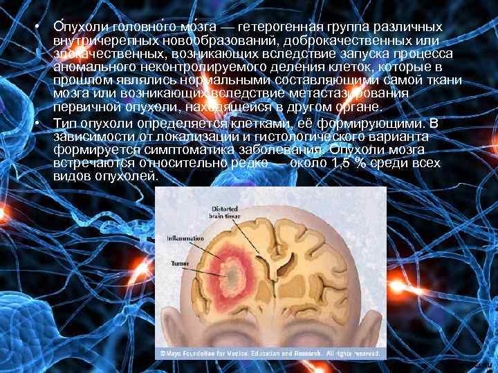  • О пухоли головно го мо зга — гетерогенная группа различных внутричерепных новообразований,