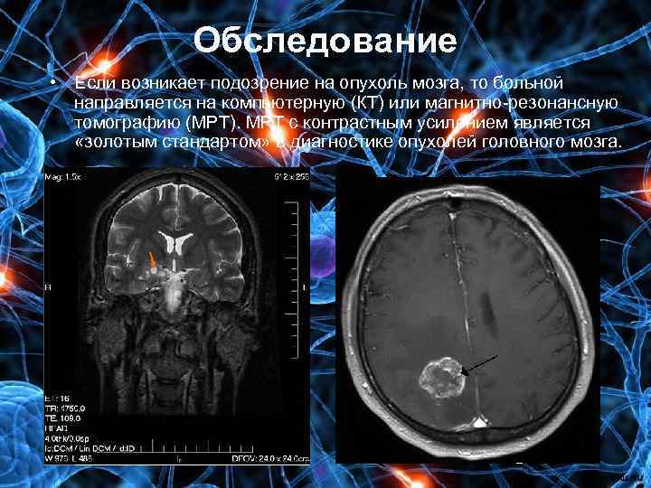 Обследование • Если возникает подозрение на опухоль мозга, то больной направляется на компьютерную (КТ)