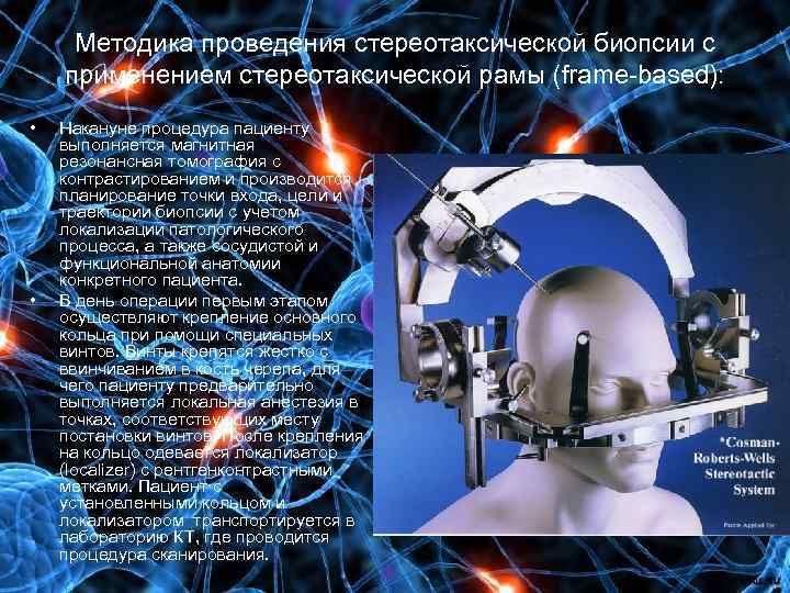 Методика проведения стереотаксической биопсии с применением стереотаксической рамы (frame-based): • • Накануне процедура пациенту
