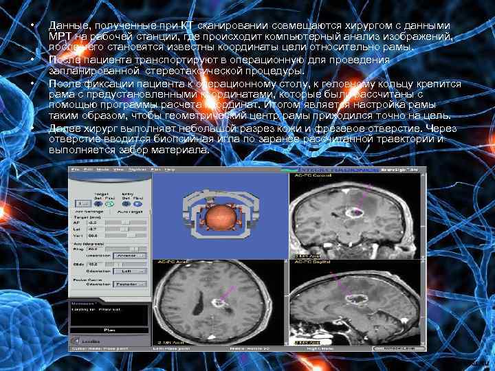 • • Данные, полученные при КТ сканировании совмещаются хирургом с данными МРТ на