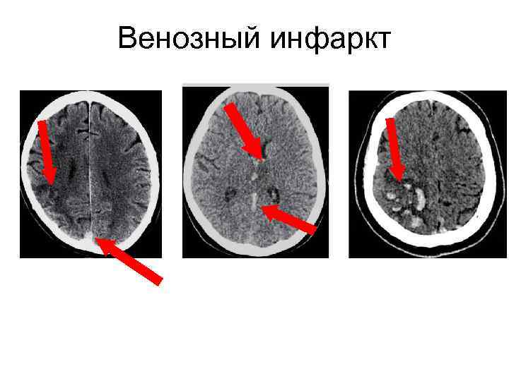 Венозный инфаркт 
