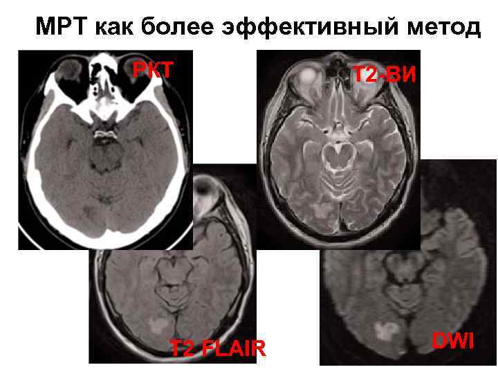 МРТ как более эффективный метод РКТ Т 2 FLAIR Т 2 -ВИ DWI 