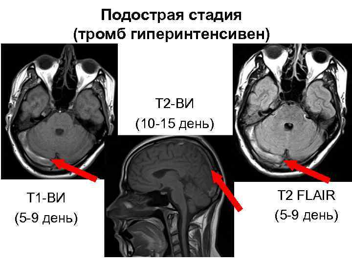 Подострая стадия (тромб гиперинтенсивен) Т 2 -ВИ (10 -15 день) Т 1 -ВИ (5