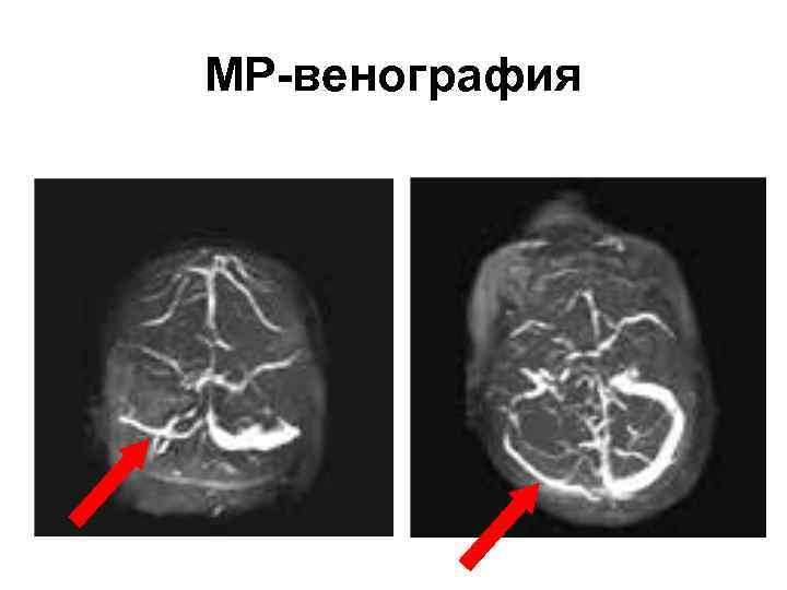 МР-венография 