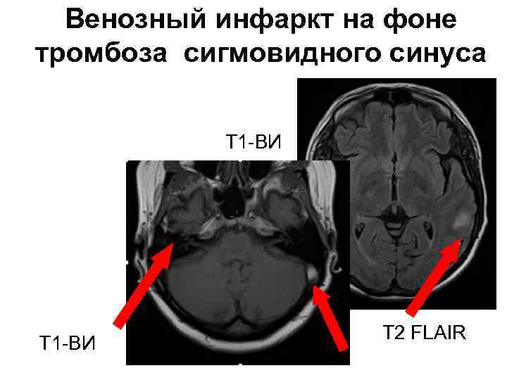 Венозный инфаркт на фоне тромбоза сигмовидного синуса Т 1 -ВИ Т 2 FLAIR 