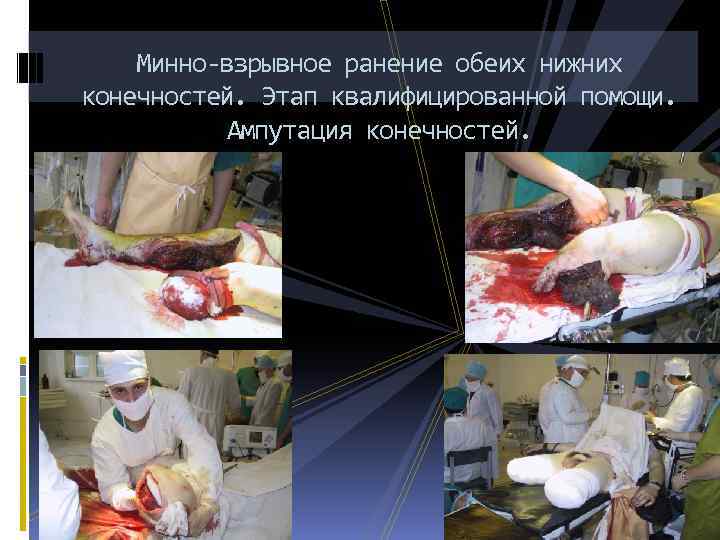 Минно-взрывное ранение обеих нижних конечностей. Этап квалифицированной помощи. Ампутация конечностей. 