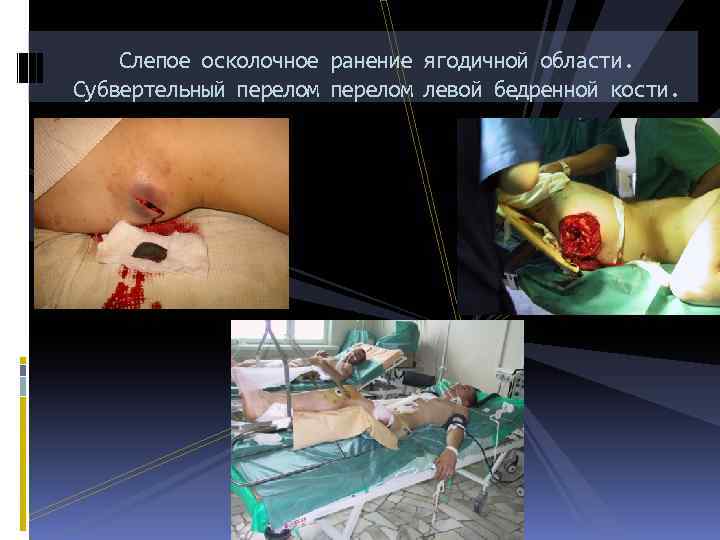 Слепое осколочное ранение ягодичной области. Субвертельный перелом левой бедренной кости. 