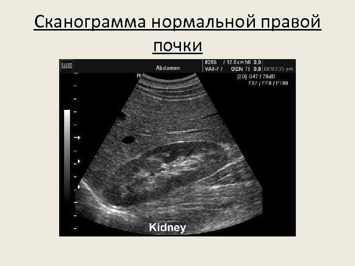 Сканограмма нормальной правой почки 