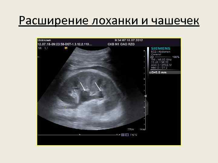 Расширение лоханки и чашечек 