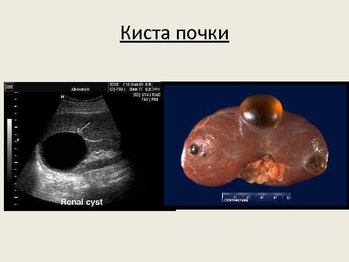 Киста почки 
