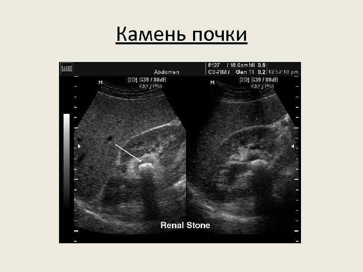 Камень почки 