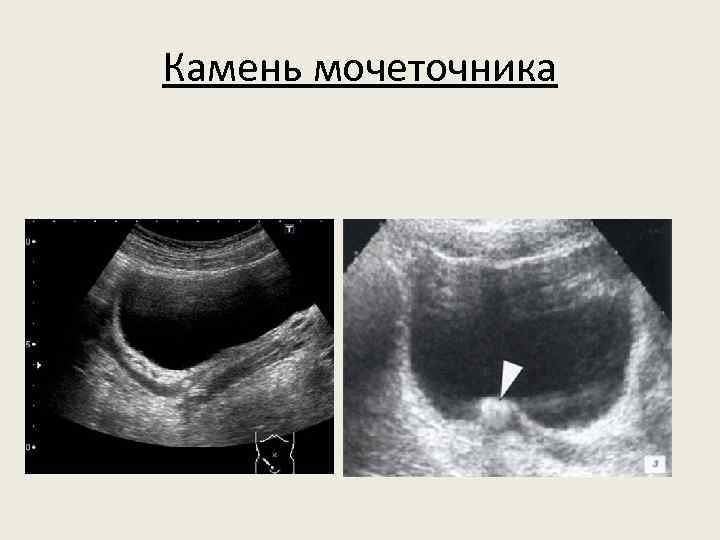 Камень мочеточника 