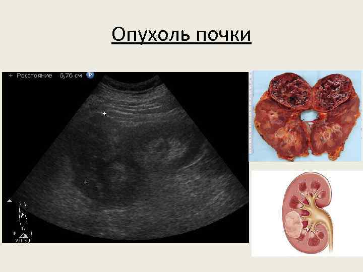 Опухоль почки 