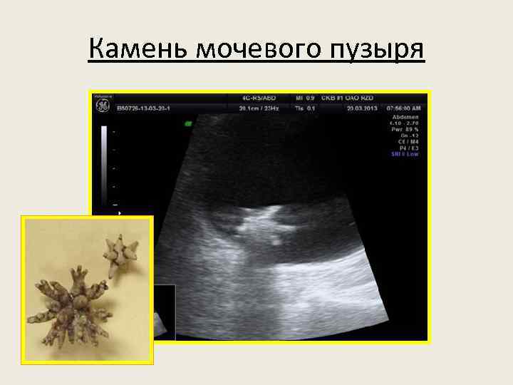 Камень мочевого пузыря 