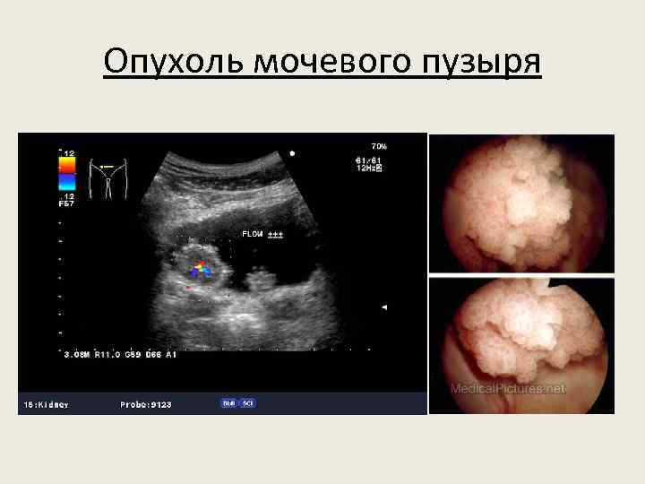 Опухоль мочевого пузыря 