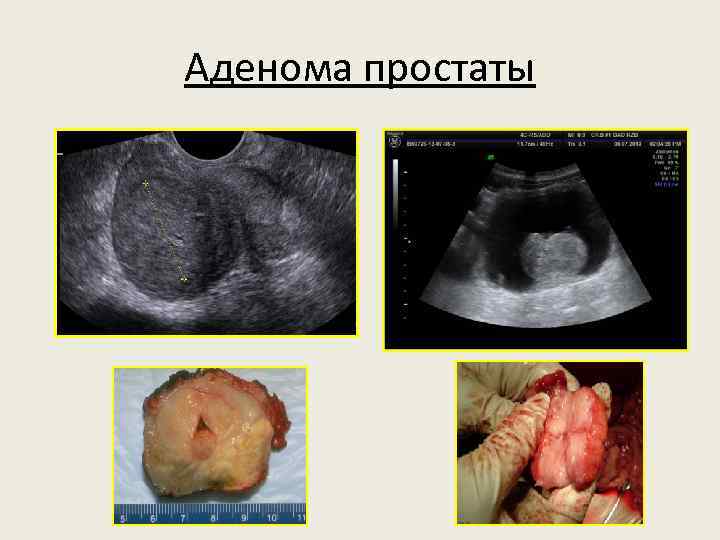 Аденома простаты 