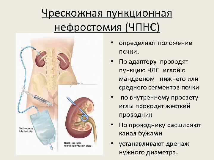 Чрескожная пункционная нефростомия (ЧПНС) • определяют положение почки. • По адаптеру проводят пункцию ЧЛС