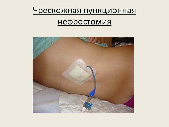 Чрескожная пункционная нефростомия 