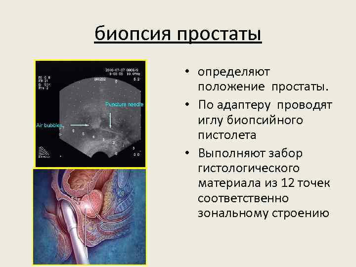 биопсия простаты • определяют положение простаты. • По адаптеру проводят иглу биопсийного пистолета •