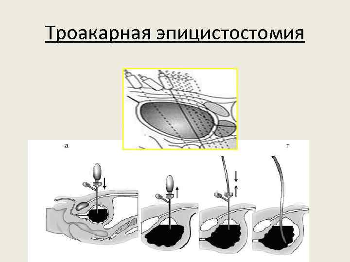 Троакарная эпицистостомия 
