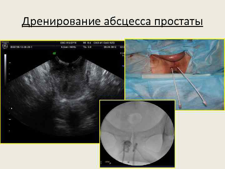 Дренирование абсцесса простаты 