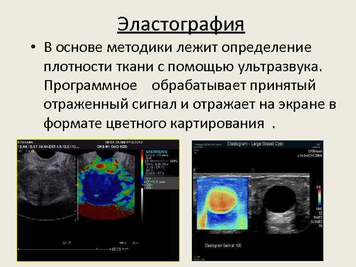 Эластография • В основе методики лежит определение плотности ткани с помощью ультразвука. Программное обрабатывает