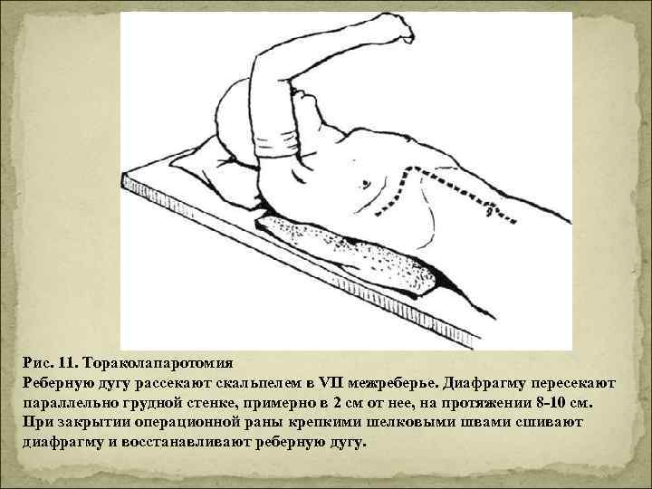 Рис. 11. Тораколапаротомия Реберную дугу рассекают скальпелем в VII межреберье. Диафрагму пересекают параллельно грудной