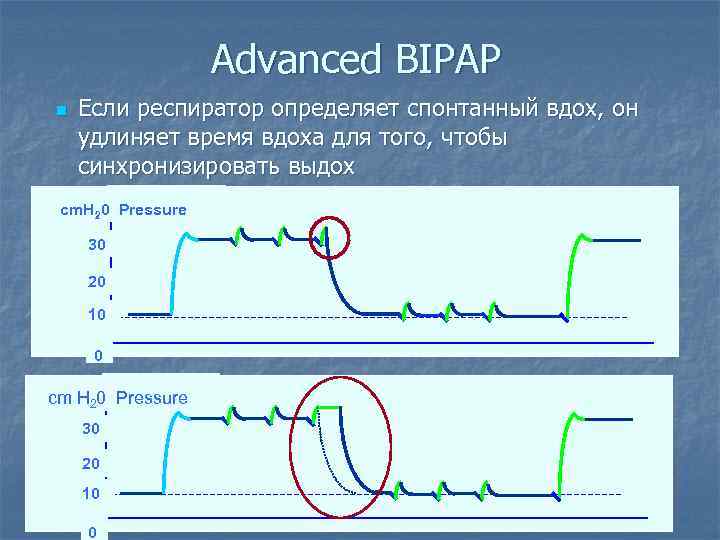 Advanced BIPAP n Если респиратор определяет спонтанный вдох, он удлиняет время вдоха для того,