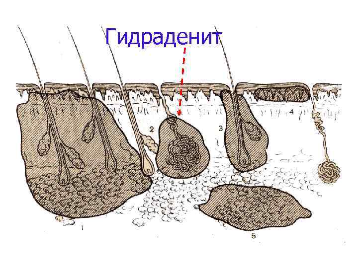 Гидраденит фурункул 