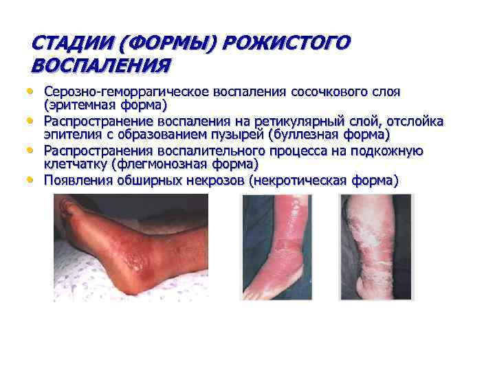 СТАДИИ (ФОРМЫ) РОЖИСТОГО ВОСПАЛЕНИЯ • Серозно-геморрагическое воспаления сосочкового слоя • • • (эритемная форма)