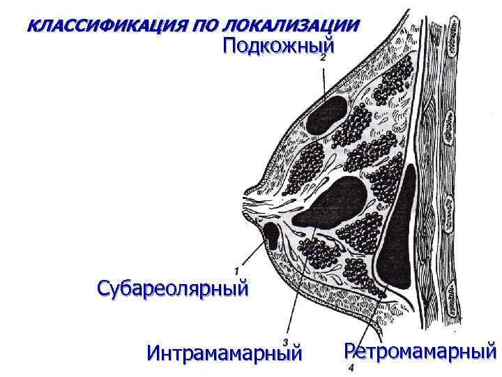 КЛАССИФИКАЦИЯ ПО ЛОКАЛИЗАЦИИ Подкожный Субареолярный Интрамамарный Ретромамарный 