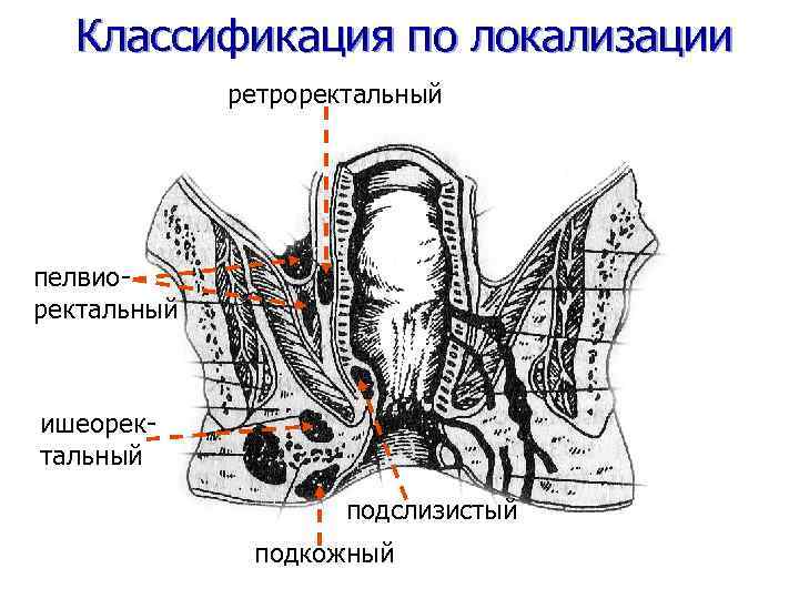 Классификация по локализации ретроректальный пелвиоректальный ишеоректальный подслизистый подкожный 