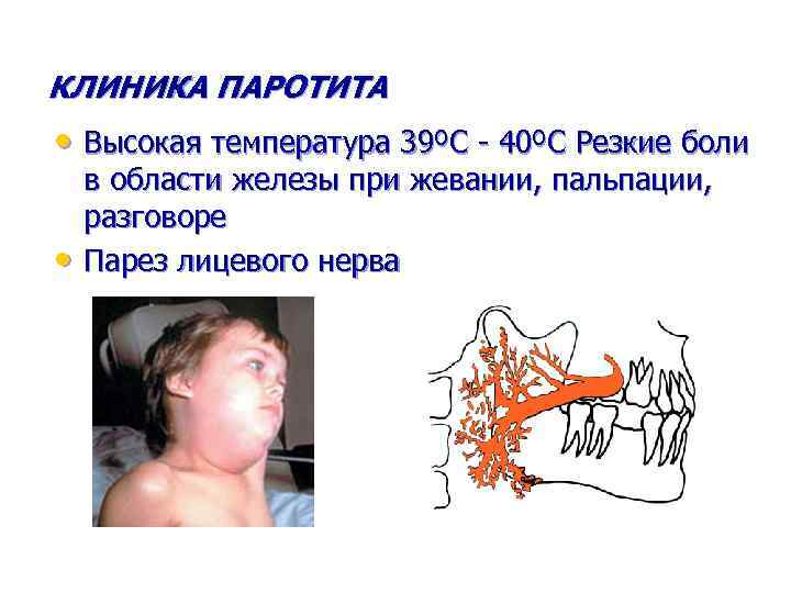 КЛИНИКА ПАРОТИТА • Высокая температура 39ºС - 40ºС Резкие боли • в области железы