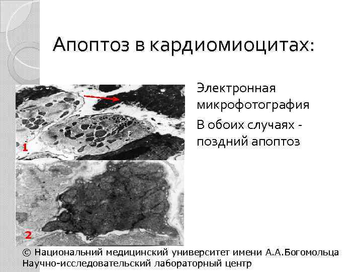 Апоптоз в кардиомиоцитах: 1 Электронная микрофотография В обоих случаях - поздний апоптоз 2 ©