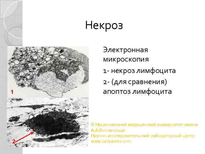 Некроз 1 2 Электронная микроскопия 1 - некроз лимфоцита 2 - (для сравнения) апоптоз