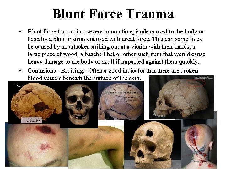 Blunt Force Trauma • Blunt force trauma is a severe traumatic episode caused to